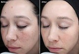 Facial Peels