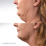 CoolSculpting | Underchin