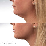 CoolSculpting | Underchin