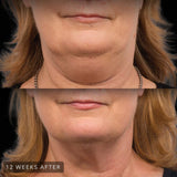 CoolSculpting | Underchin