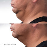 CoolSculpting | Underchin