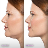 Kybella