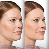 Kybella