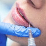 Medical provider preparing to inject Juvederm hyaluronic dermal filler into lips. for lip augmentation.