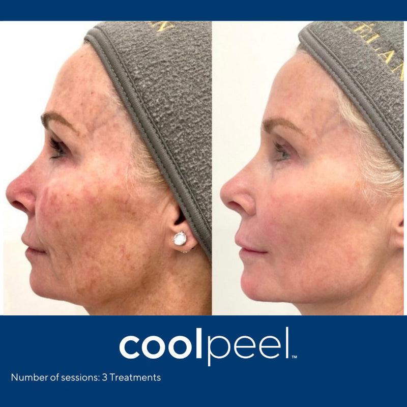 DEKA CoolPeel - Tetra SmartXide CO2 Facial
