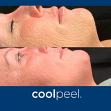 DEKA CoolPeel - Tetra SmartXide CO2 Facial