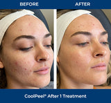 DEKA CoolPeel - Tetra SmartXide CO2 Facial