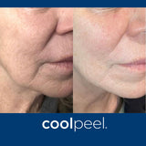DEKA CoolPeel - Tetra SmartXide CO2 Facial