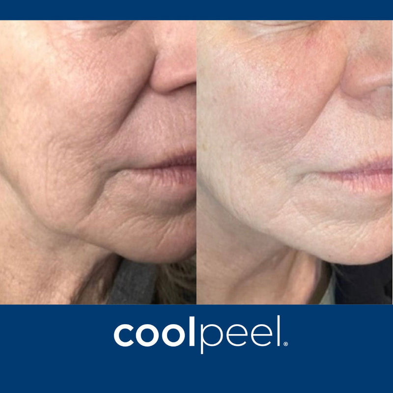 DEKA CoolPeel - Tetra SmartXide CO2 Facial