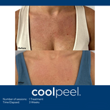 DEKA CoolPeel - Tetra SmartXide CO2 Facial