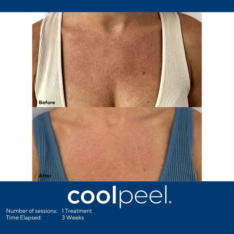DEKA CoolPeel - Tetra SmartXide CO2 Facial