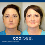 DEKA CoolPeel - Tetra SmartXide CO2 Facial