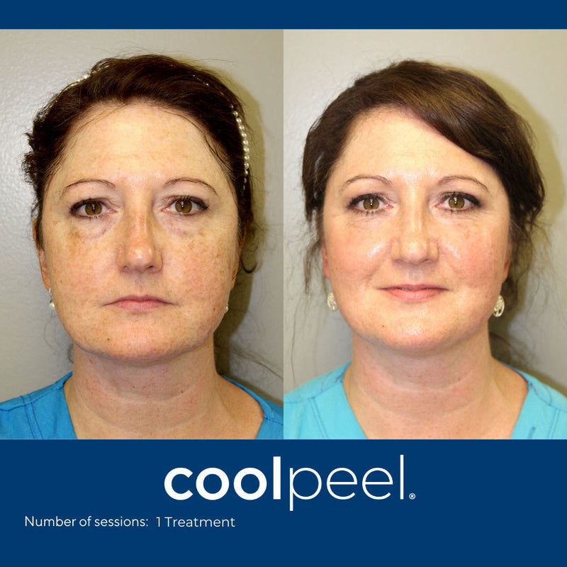 DEKA CoolPeel - Tetra SmartXide CO2 Facial